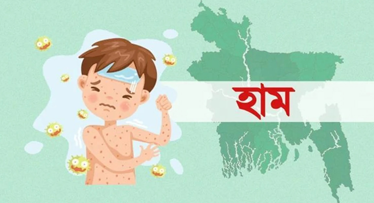 হাম ও হামের উপসর্গে ২৪ ঘণ্টায় আরও ১৬ জনের মৃত্যু