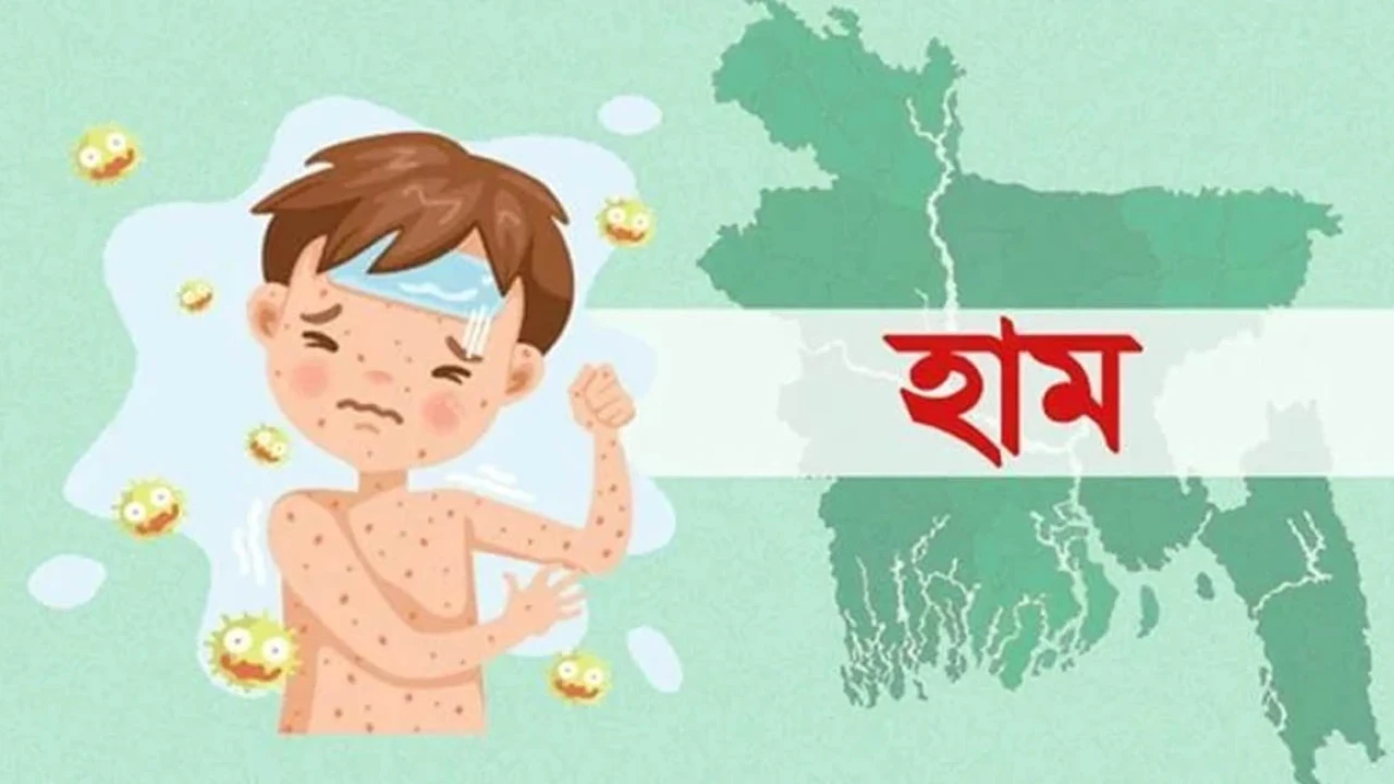 হামের উপসর্গ নিয়ে আরও এক শিশুর মৃত্যু